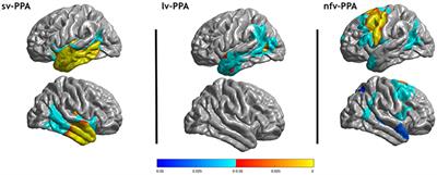 Structural, Microstructural, and Metabolic Alterations in Primary Progressive Aphasia Variants